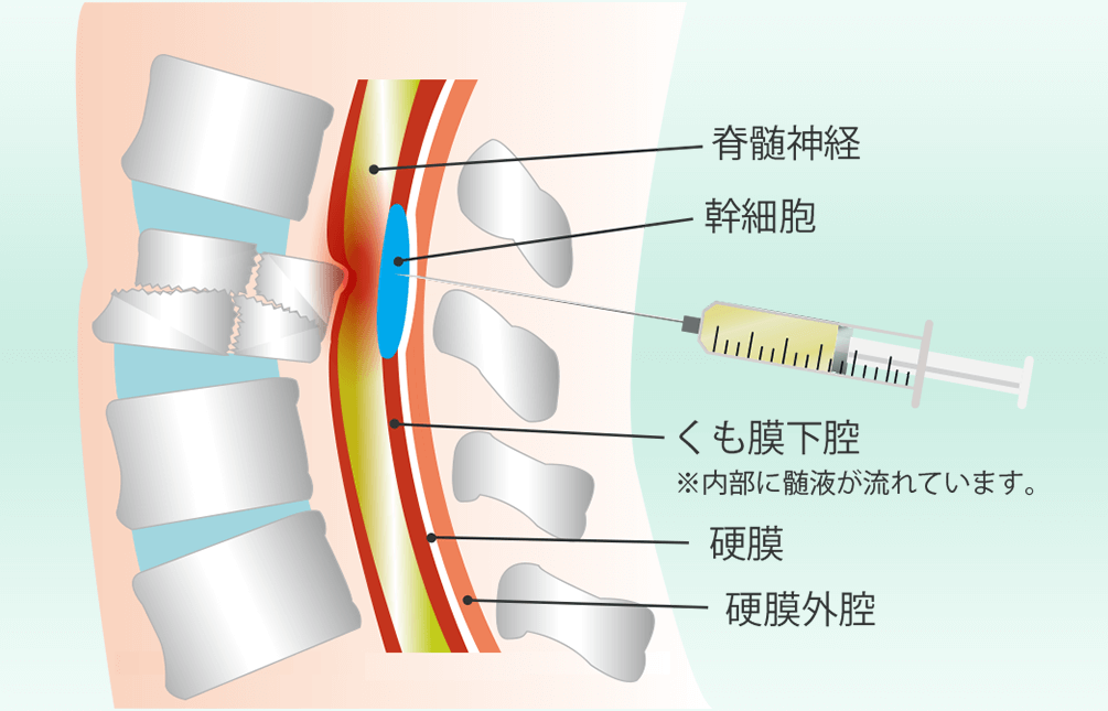 図：脊髄腔内ダイレクト注射療法
