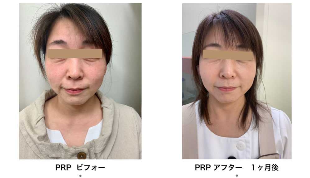 PRP皮膚再生医療の前後比較