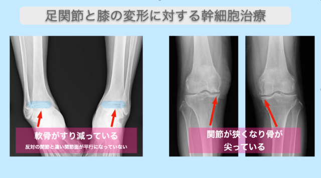 足関節と膝関節の変形に対する再生医療