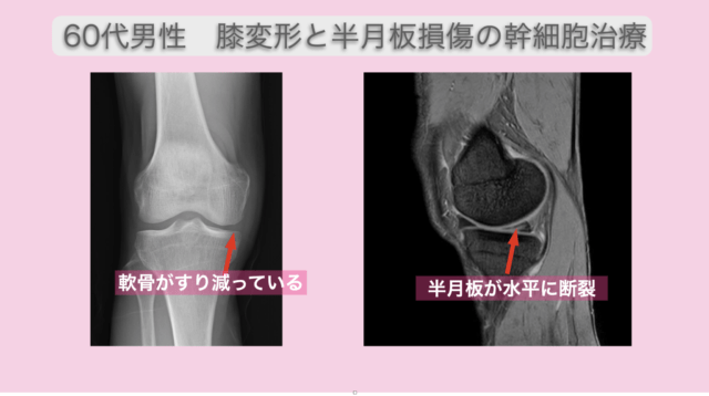 ひざの変形と半月板損傷に幹細胞治療