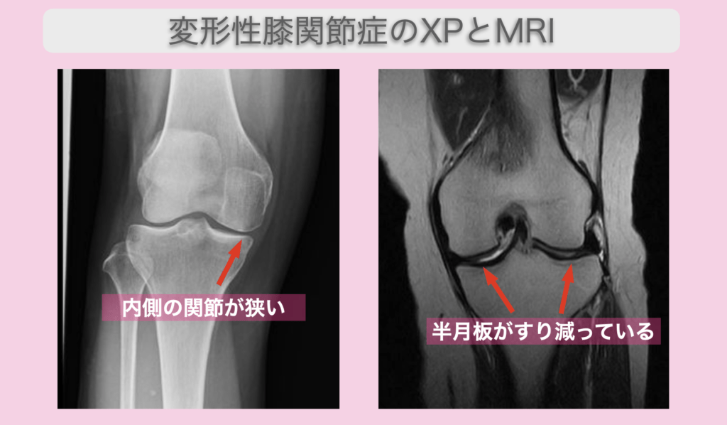 変形性膝関節症と半月板損傷に対する幹細胞治療