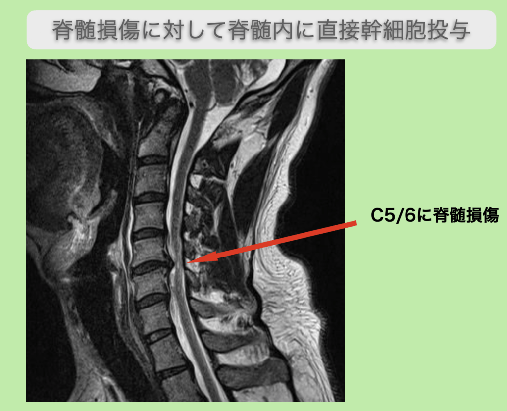 脊髄損傷に対する脊髄内幹細胞投与
