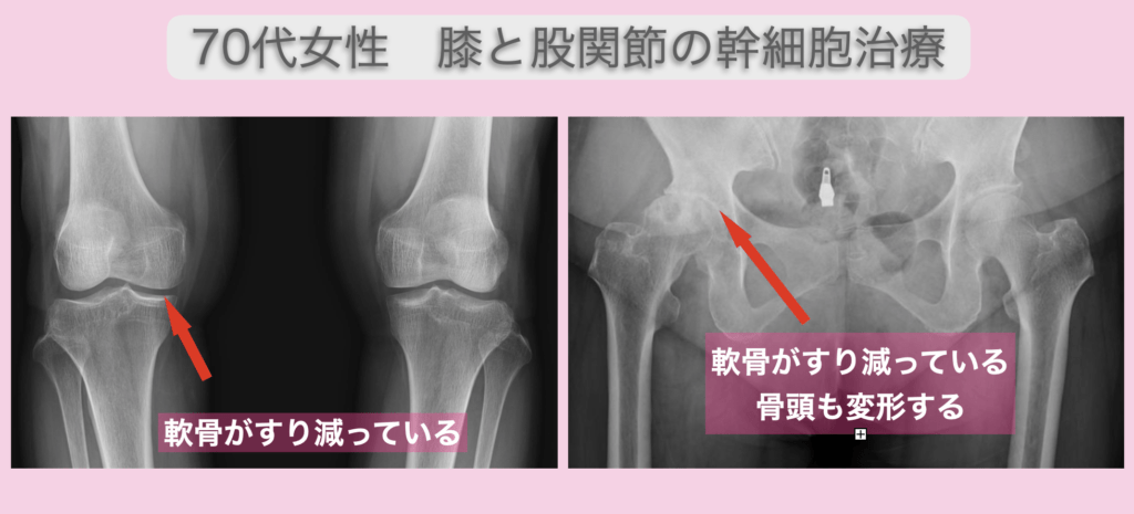 膝と股関節の幹細胞治療
