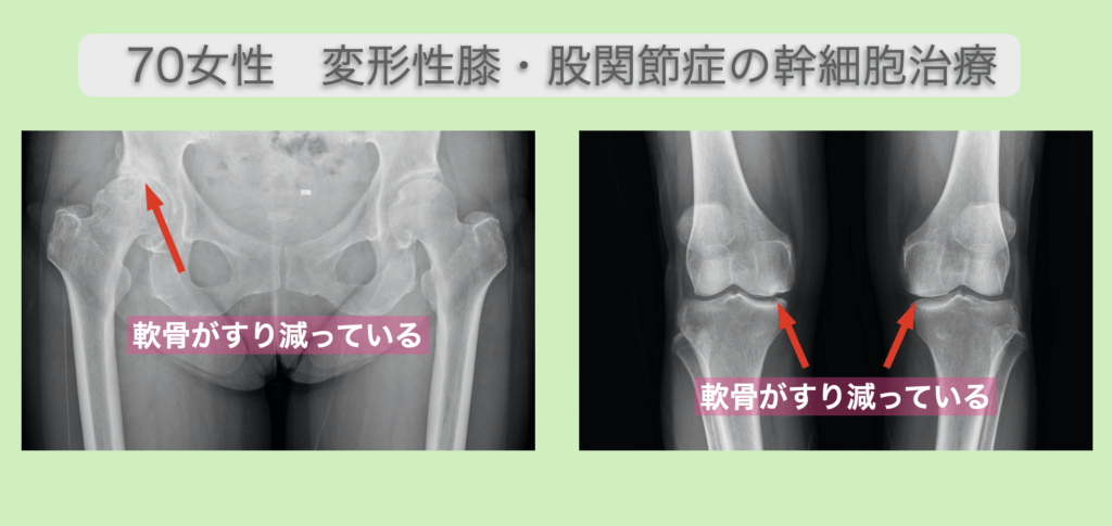 変形性膝関節症と変形性股関節症のレントゲン