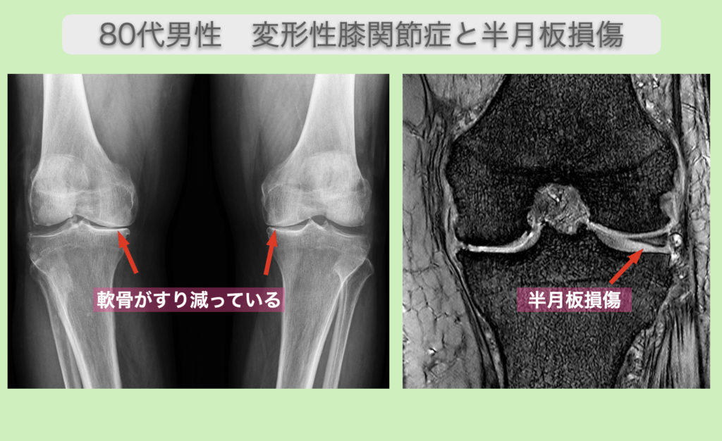 変形性膝関節症と半月板損傷の幹細胞治療